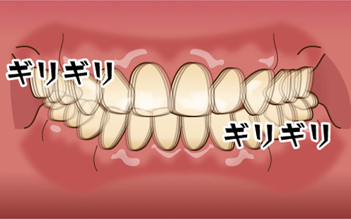 やめたい 歯ぎしり